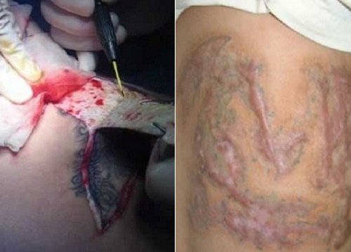 xóa hình xăm ở tay 10