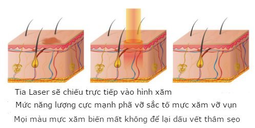 xóa hình xăm ở tay 6