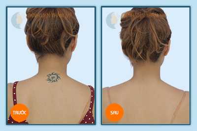 Xóa hình xăm sau gáy 3