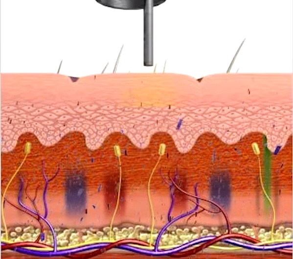 Cơ chế tác động xóa xăm an toàn