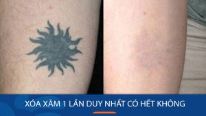 Xóa xăm 1 lần duy nhất có hết không? – Chia sẻ kinh nghiệm xóa xăm