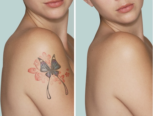 Hình ảnh sau khi xóa hình xăm bằng Laser Toning Plus xoa xam laser toning plus hieu qua nhanh