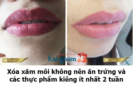 xóa xăm kiêng ăn gì3