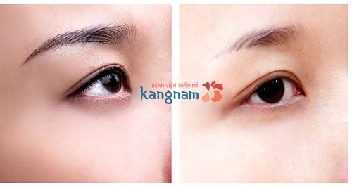 tranh-ton-thuong-khi-xoa-xam-mi-mat-3