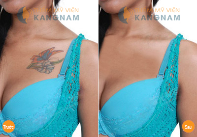 Kết quả xóa hình xăm bằng công nghệ Laser Toning Plus cach cham soc da sau xoa xam