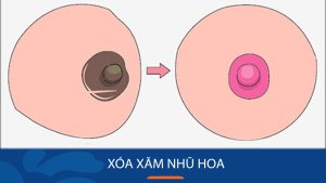 Có cách nào xóa xăm nhũ hoa an toàn và hiệu quả không?