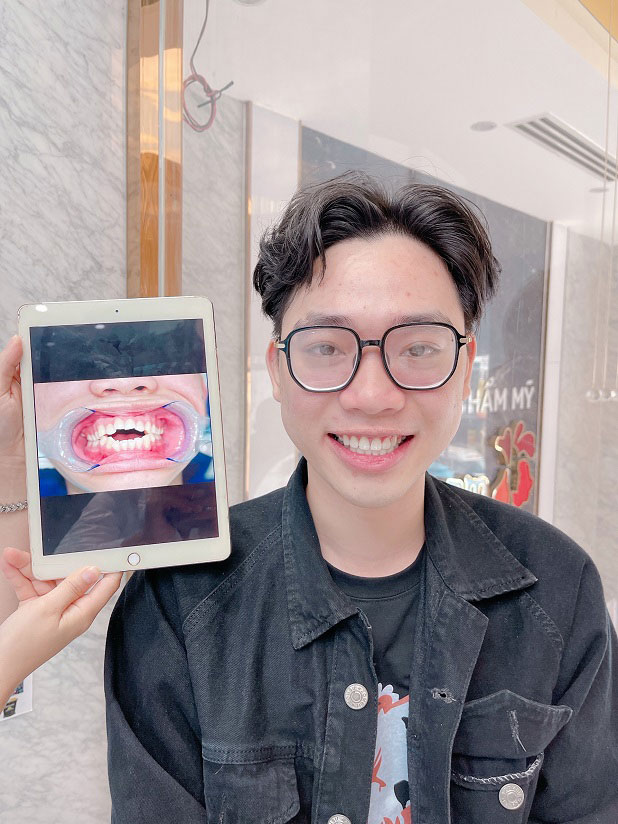 Cải thiện tối đa tình trạng răng khấp khểnh không đều