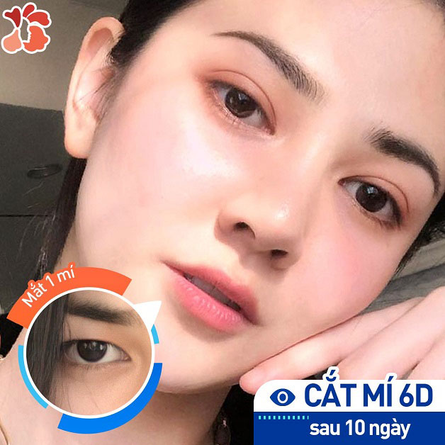 Cắt mí mắt có ảnh hưởng tới thị lực không?