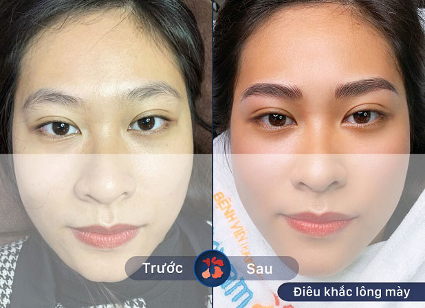 Khách hàng da nhờn điêu khắc Hairstroke đẹp tại Kangnam