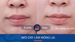 Môi dày làm mỏng lại “không cần phẫu thuật” quyến rũ