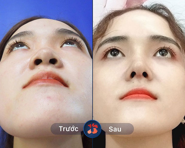 lỗ mũi hạt chanh