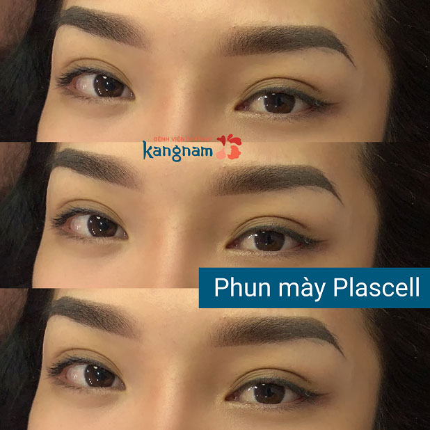 Phun mày Plascell hồi phục siêu nhanh, form dáng cân đối