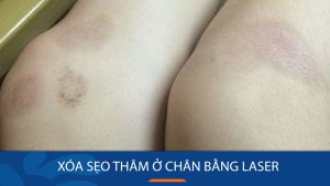 Xóa sẹo thâm ở chân vĩnh viễn bằng Laser: Bí quyết lấy lại làn da mịn màng