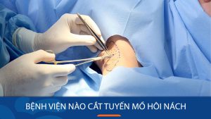 Bệnh viện nào cắt tuyến mồ hôi nách hiệu quả dứt điểm?