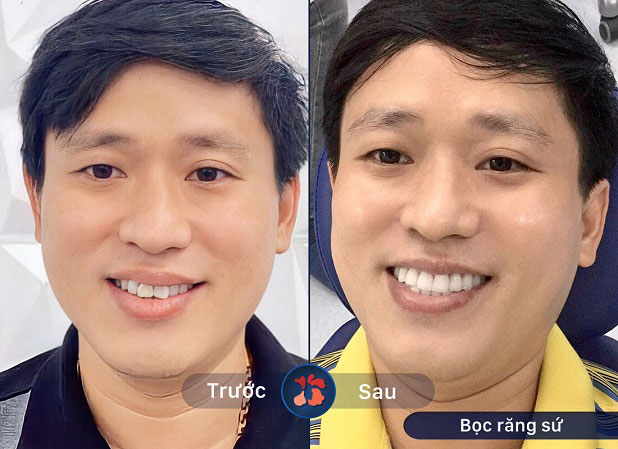 Bọc răng sứ cải thiện tình trạng răng khấp khểnh nhẹ