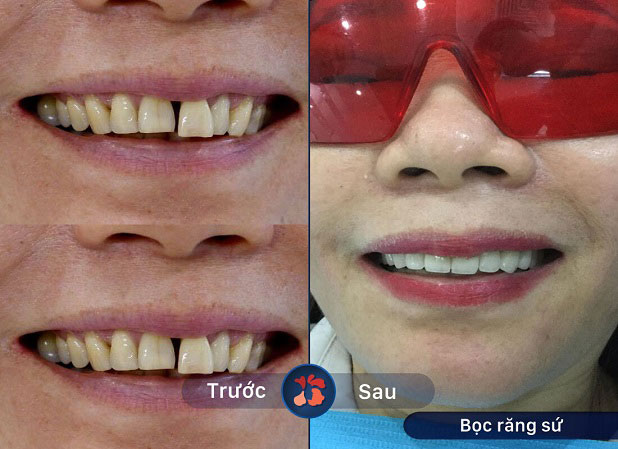 Khắc phục hoàn hảo tình trạng răng xin màu, ố vàng