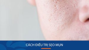 9 Cách Điều Trị Sẹo Mụn Hiệu Quả Nhất 2025