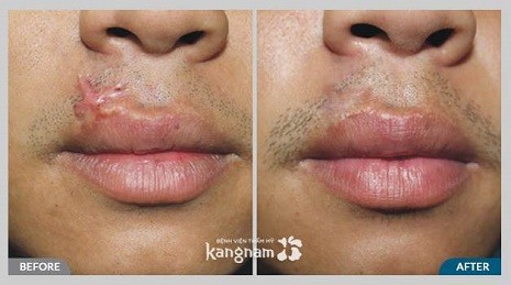 Phần mô sẹo xấu đã được xử lý, trả lại đôi môi mềm mịn