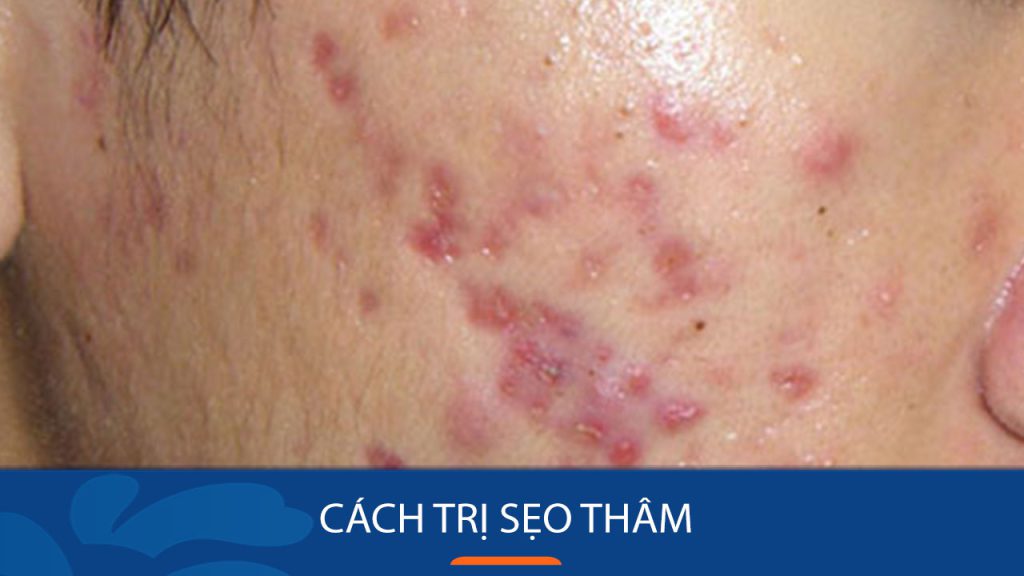 Cách trị sẹo thâm: Bí quyết đánh bay sẹo thâm chỉ trong 7 ngày