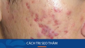 Cách trị sẹo thâm: Bí quyết đánh bay sẹo thâm chỉ trong 7 ngày