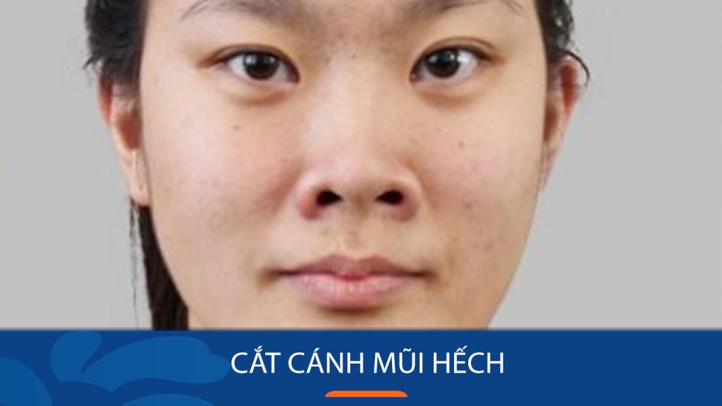 Cắt cánh mũi hếch là gì? Khi nào nên thực hiện và những điều cần biết