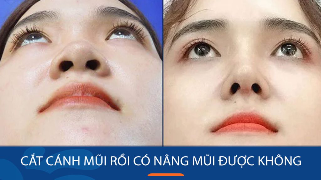 Cắt cánh mũi rồi có nâng mũi được không? Trường hợp có thể và lưu ý quan trọng