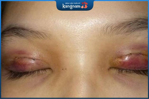 Nhiễm trùng sau cắt mí là biến chứng đáng lo ngại