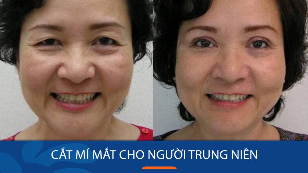Cắt mí mắt cho người trung niên: Khi nào nên làm và những điều cần biết