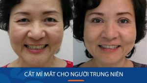 Cắt mí mắt cho người trung niên: Khi nào nên làm và những điều cần biết