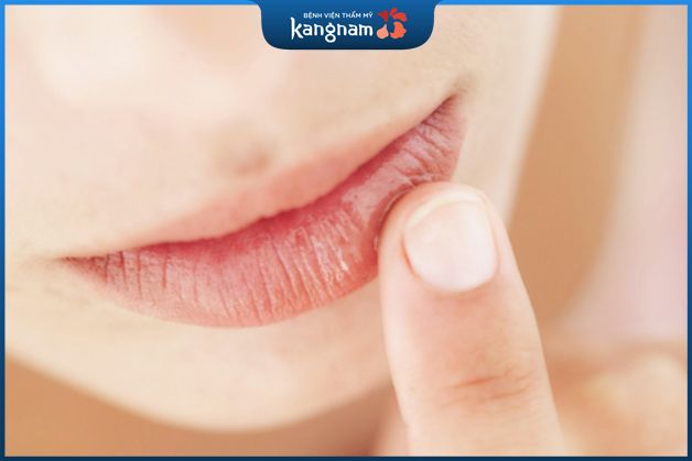 Chú ý chăm sóc môi để kết quả tiêm filler chuẩn