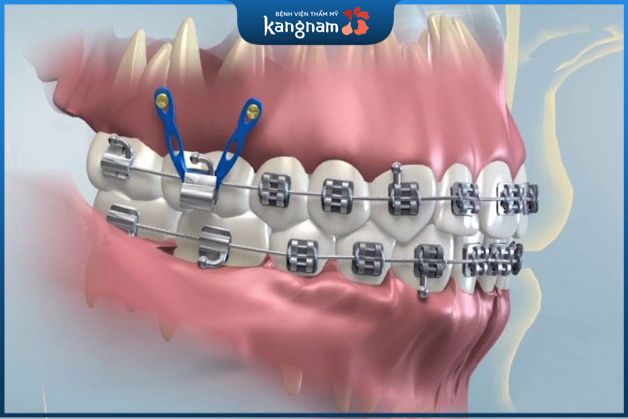 Đánh lún răng chữa cười hở lợi