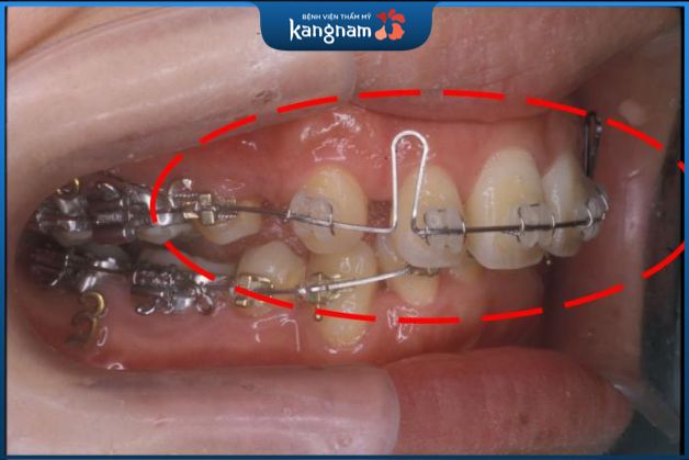 đánh lún răng bằng dây cung có sử dụng dây cung CNA với kích thước