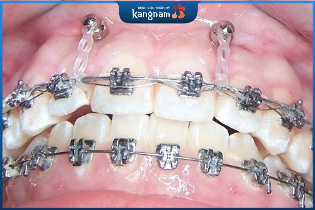 Sử dụng minivis đánh lún răng