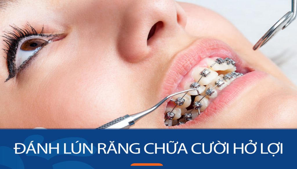 Đánh lún răng chữa cười hở lợi là gì? Lợi ích đánh lún răng