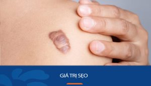 Chi phí xóa sẹo giá bao nhiêu? Giá trị sẹo lồi, rỗ, thâm mới nhất