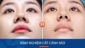Top 6 Kinh nghiệm cắt cánh mũi thành công cho bất cứ ai lần đầu làm đẹp