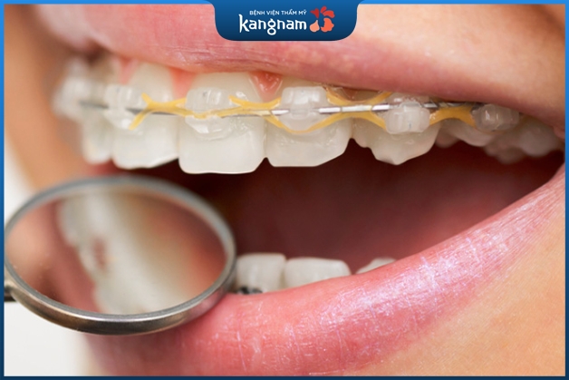 Lưu ý khi niềng răng mắc cài pha lê