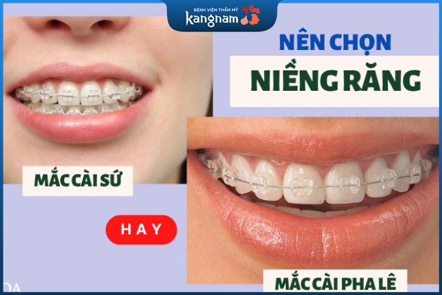 Nên niềng răng mắc cài pha lê hay niềng răng mắc cài sứ?