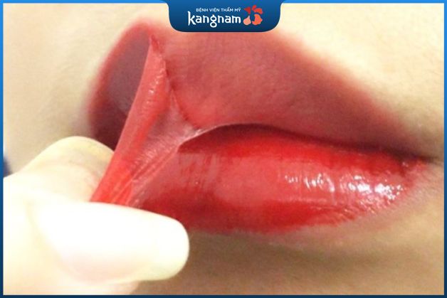 Môi bong nhanh sau 2 ngày dễ tiềm ẩn biến chứng
