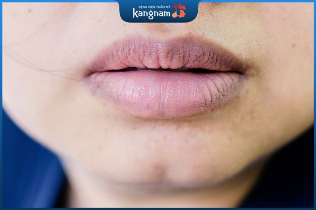 Môi thâm ảnh hưởng tới kết quả phun dặm