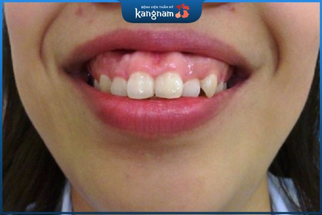 Cười hở lợi xuất phát từ nhiều nguyên nhân