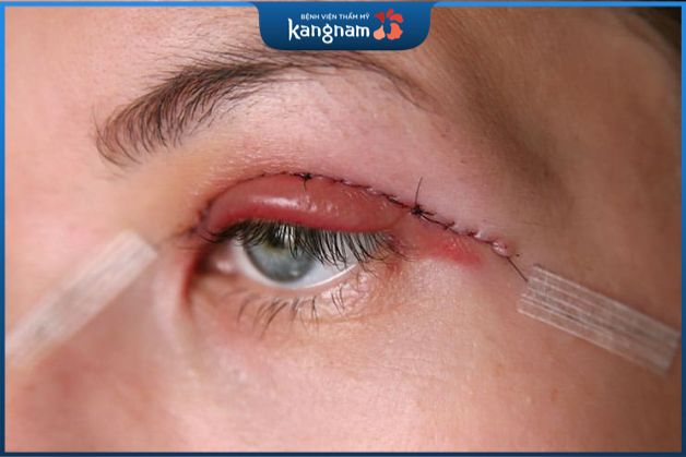 Mắt sưng tím sau khi cắt mí