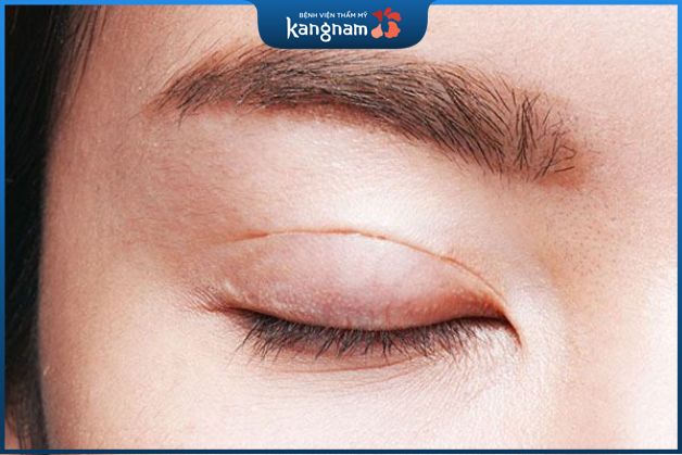 Công nghệ sử dụng tia plasma tạo đường mí ngay tức thì, nhẹ nhàng