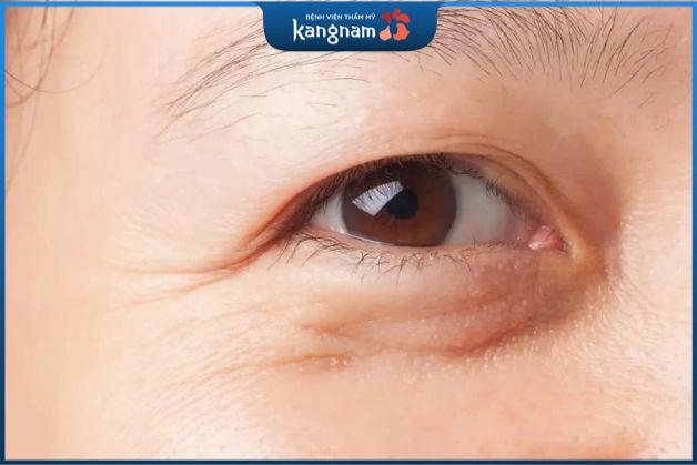 Những người có nhiều da thừa, mỡ thừa