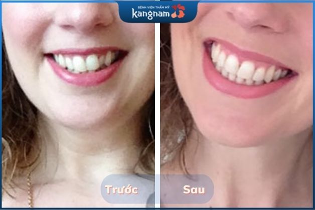 Răng khấp khểnh được khắc phục hiệu quả