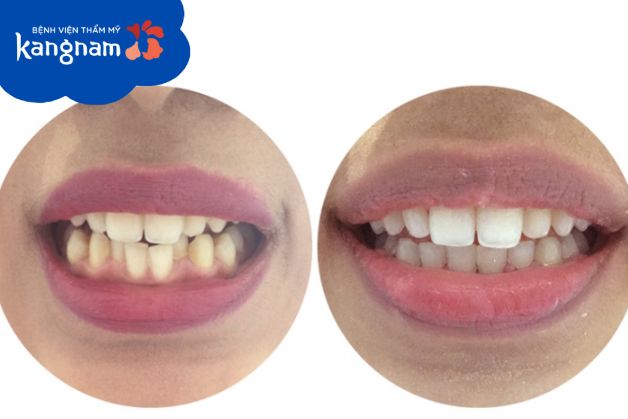 Niềng răng mắc cài pha lê giá bao nhiêu