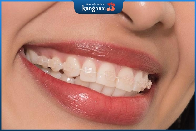 Niềng răng mắc cài pha lê có tốt không?