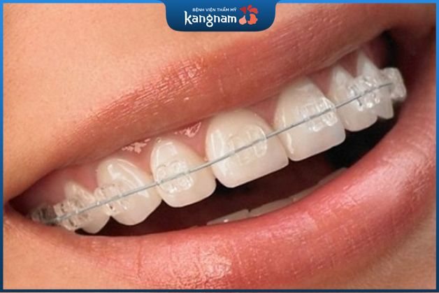 Niềng mắc cài pha lê có thể duy trì vĩnh viễn