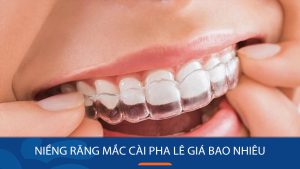 Niềng răng mắc cài pha lê giá bao nhiêu? Những lưu ý quan trọng