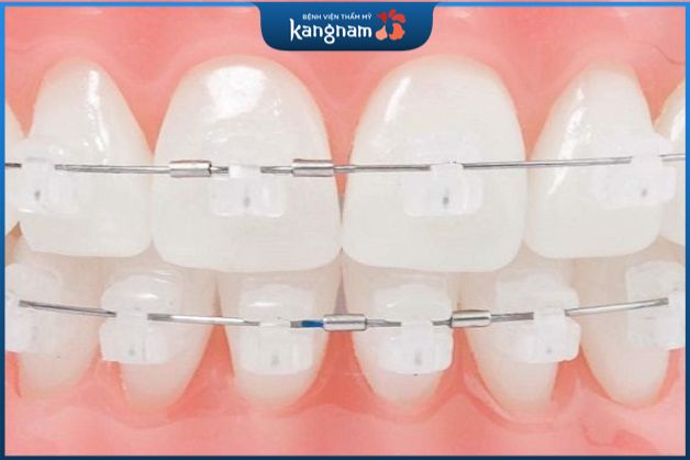 Mắc cài pha lê có lực kéo yếu hơn so với mắc cài kim loại và sứ